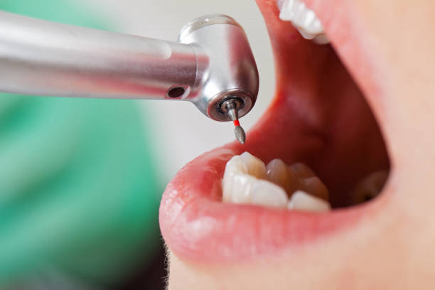Best Emergency Dentist for Lost Fillings or Crowns in Jordan, NY
